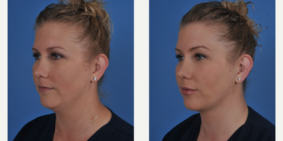 Kybella before and after photo