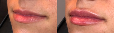 Lip Fillers before and after photo