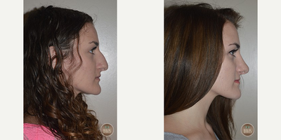 Rhinoplasty before and after photo