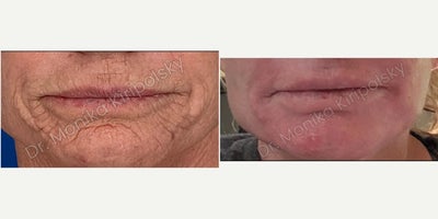Chemical Peel before and after photo