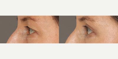 Eyelid Surgery before and after photo