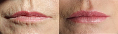 Lip Fillers before and after photo