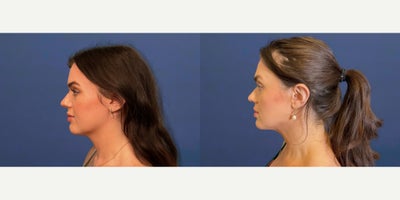 Liposuction before and after photo