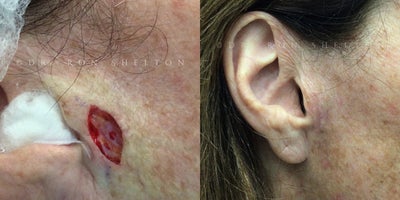 Mohs Surgery before and after photo