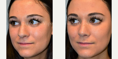 Rhinoplasty before and after photo