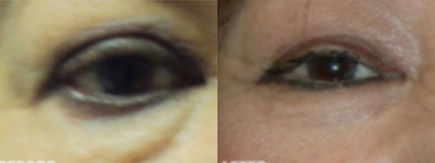 Skin Rejuvenation before and after photo