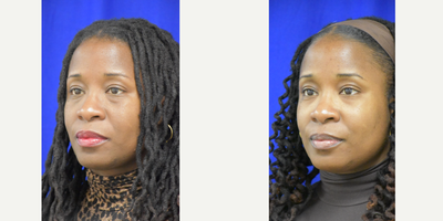 Eyelid Surgery before and after photo