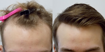 FUE Hair Transplant before and after photo