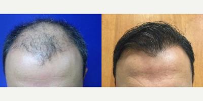 FUE Hair Transplant before and after photo
