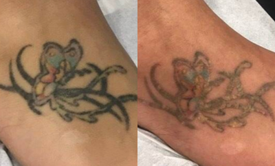 Tattoo Removal before and after photo