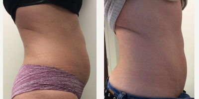 truSculpt before and after photo