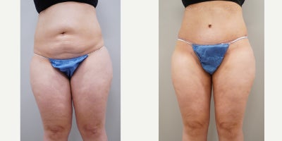 Tummy Tuck before and after photo