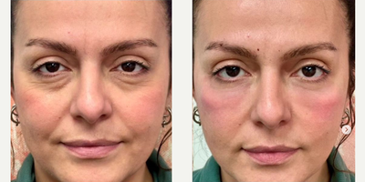 Dermal Fillers before and after photo