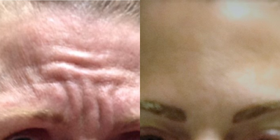 Dysport before and after photo