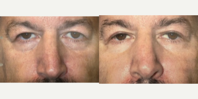 Eyelid Surgery before and after photo