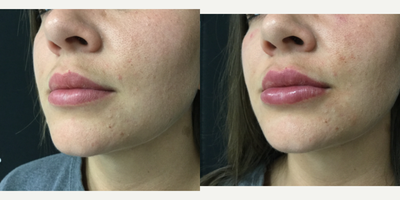 Restylane Silk before and after photo