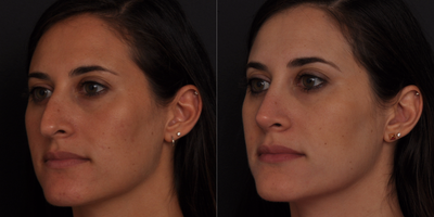 Revision Rhinoplasty before and after photo