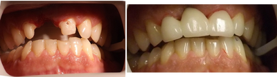Dental Crown before and after photo