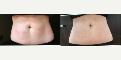 Emsculpt before and after photo