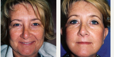 Facelift before and after photo
