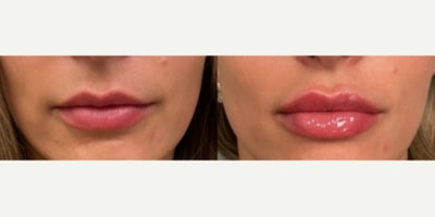Lip Fillers before and after photo