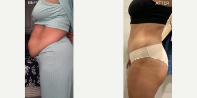 SlimLipo before and after photo