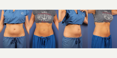 CoolSculpting before and after photo