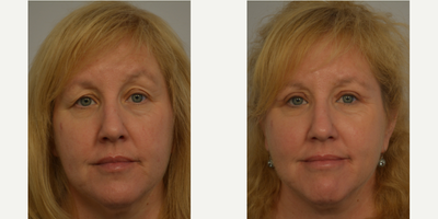 Eyelid Surgery before and after photo