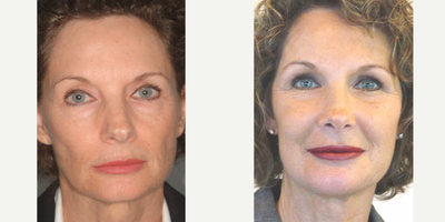 Nonsurgical Facelift before and after photo