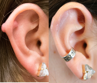 Scar Removal before and after photo