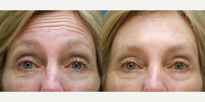 Botox before and after photo