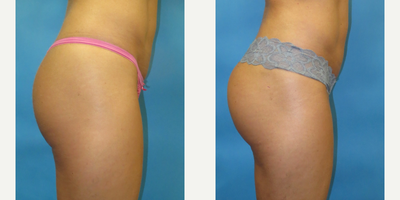 Brazilian Butt Lift before and after photo