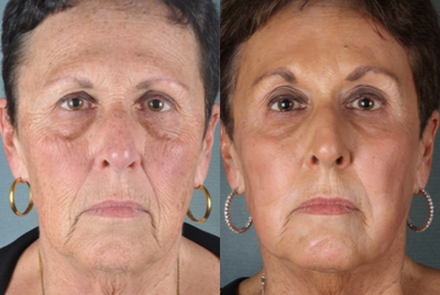 CO2 Laser before and after photo