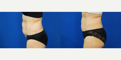 CoolSculpting before and after photo