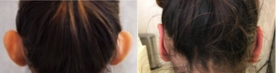 Ear Surgery before and after photo