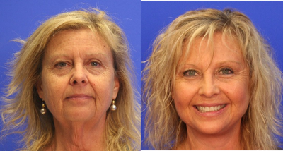 Facelift before and after photo