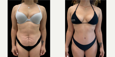 Mommy Makeover before and after photo