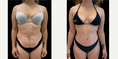 Mommy Makeover before and after photo