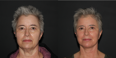 CO2 Laser before and after photo