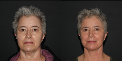 CO2 Laser before and after photo