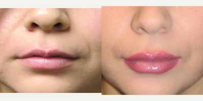 Juvederm before and after photo