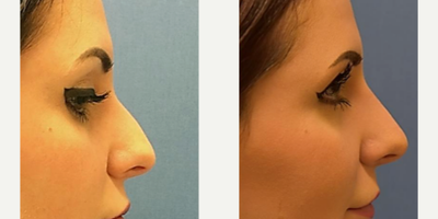 Nonsurgical Nose Job before and after photo