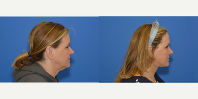 Facelift before and after photo