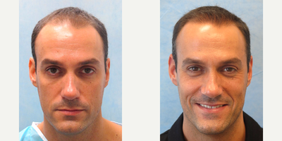 Hair Transplant before and after photo