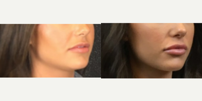 Juvederm before and after photo