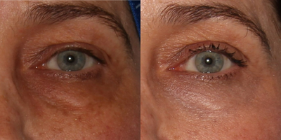 Laser Peel before and after photo