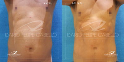 Liposuction before and after photo