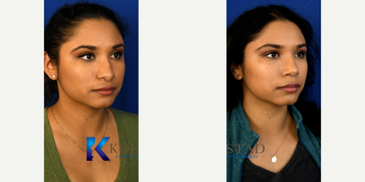 Rhinoplasty before and after photo