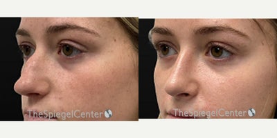 Rhinoplasty before and after photo