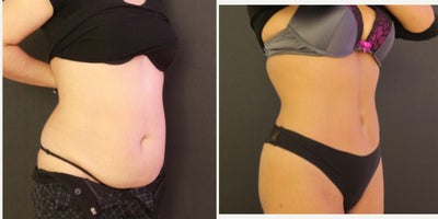 Vaser Liposuction before and after photo